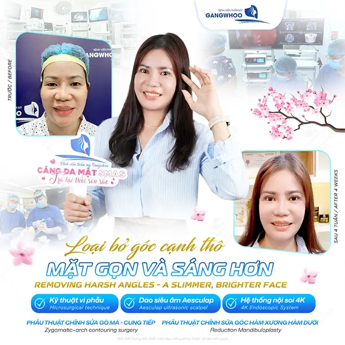 Tiêm hạ gò má giá bao nhiêu? Bảng giá hạ gò má chi tiết mới nhất 2025