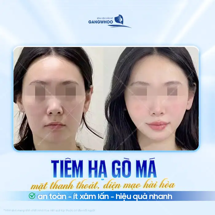 Tiêm hạ gò má giá bao nhiêu? Bảng giá hạ gò má chi tiết mới nhất 2025