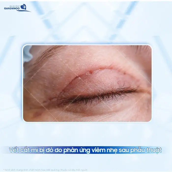 Vất cắt mí bị đỏ có phải là biến chứng? Nên khắc phục ra sao?
