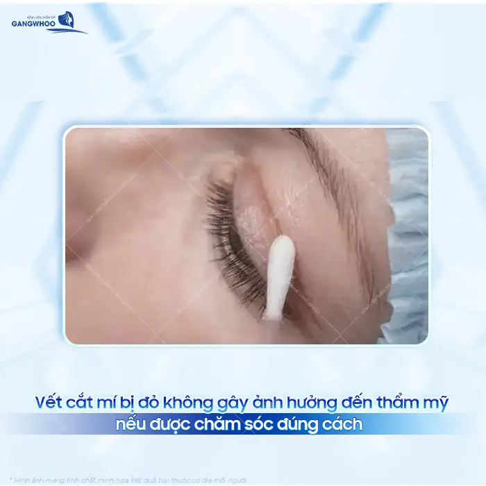 Vất cắt mí bị đỏ có phải là biến chứng? Nên khắc phục ra sao?