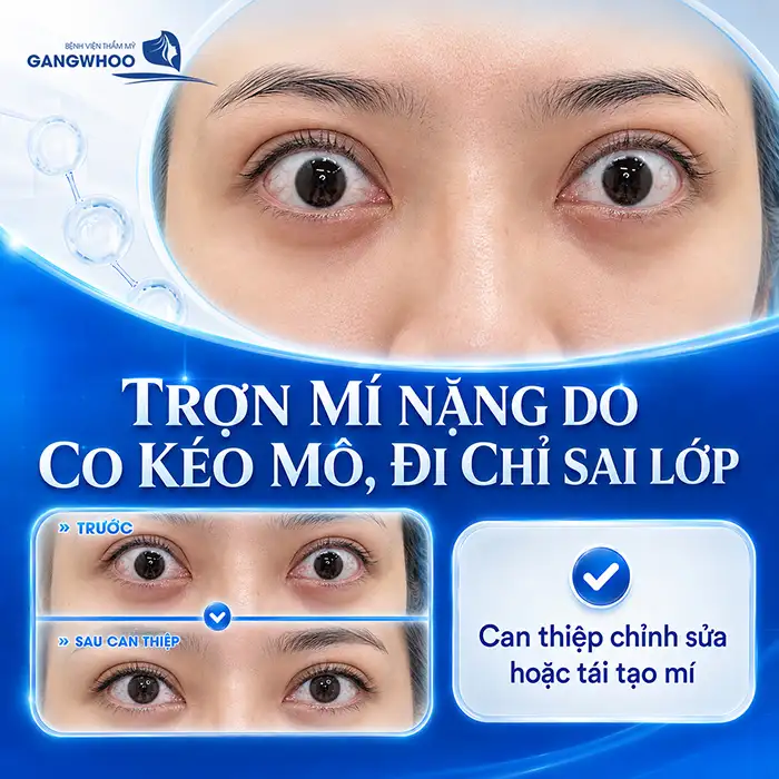Nguyên nhân bấm mí bị trợn và cách khắc phục theo từng mức độ