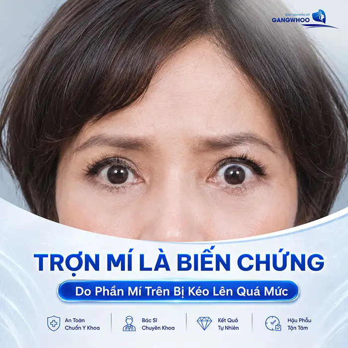 Nguyên nhân bấm mí bị trợn và cách khắc phục theo từng mức độ