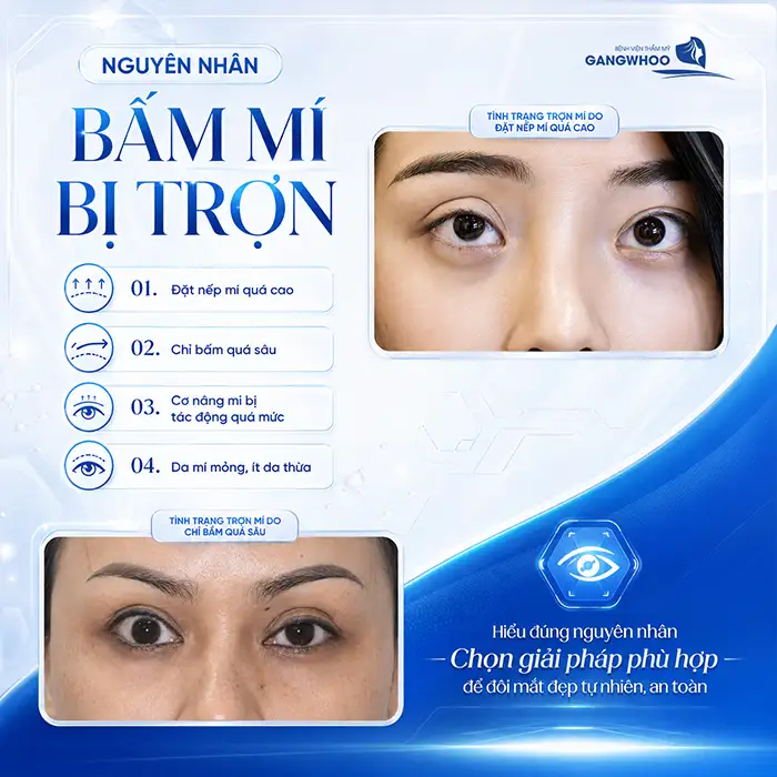 Nguyên nhân bấm mí bị trợn và cách khắc phục theo từng mức độ