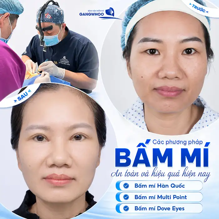 Bấm mí chỉ vàng là gì? Có hiệu quả hơn so với loại chỉ thường