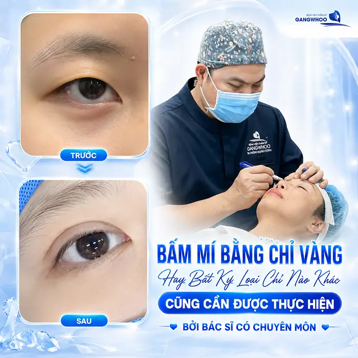Bấm mí chỉ vàng là gì? Có hiệu quả hơn so với loại chỉ thường