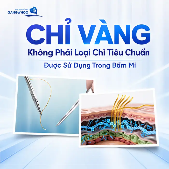 Bấm mí chỉ vàng là gì? Có hiệu quả hơn so với loại chỉ thường