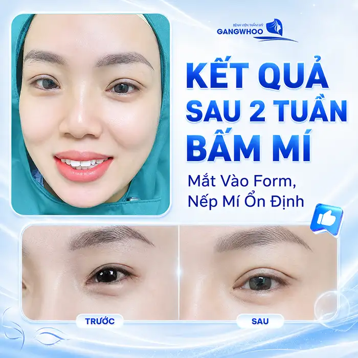 Bấm mí Hàn Quốc bao lâu hết sưng? Cách giảm sưng hiệu quả