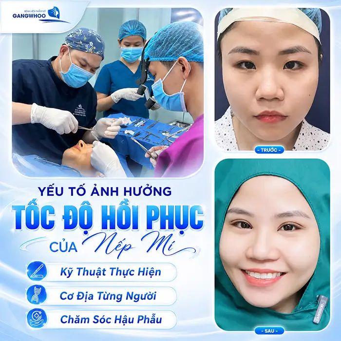 Bấm mí Hàn Quốc bao lâu hết sưng? Cách giảm sưng hiệu quả