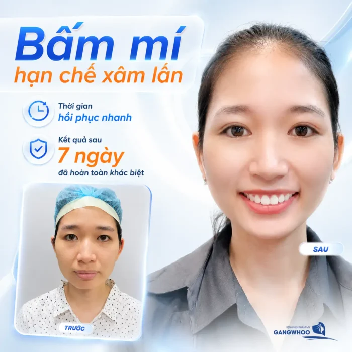Bấm mí Hàn Quốc bao nhiêu tiền? Cập nhật bảng giá bấm mí 2025