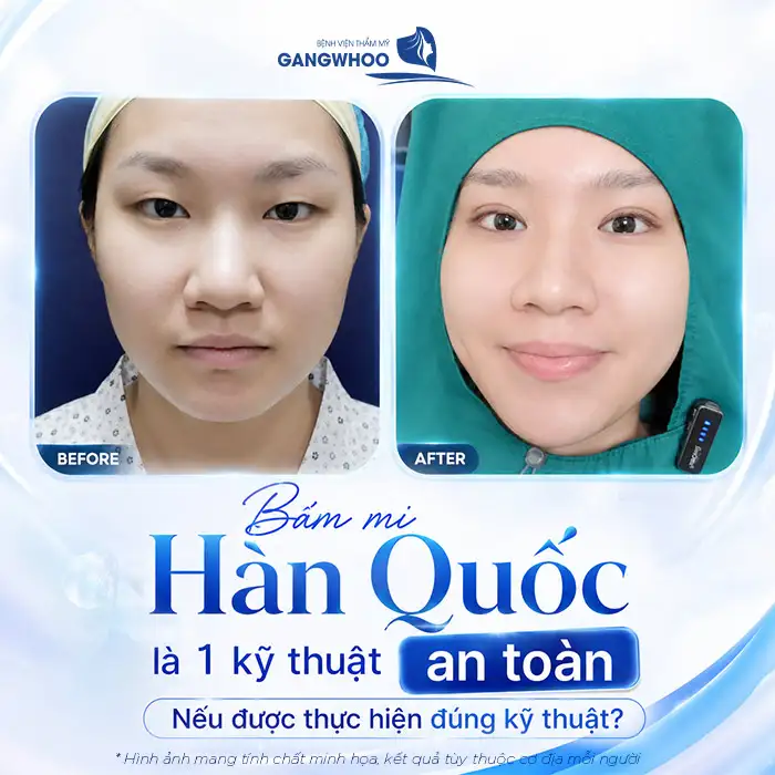 Bấm mí Hàn Quốc có an toàn không? Cần lưu ý những gì?
