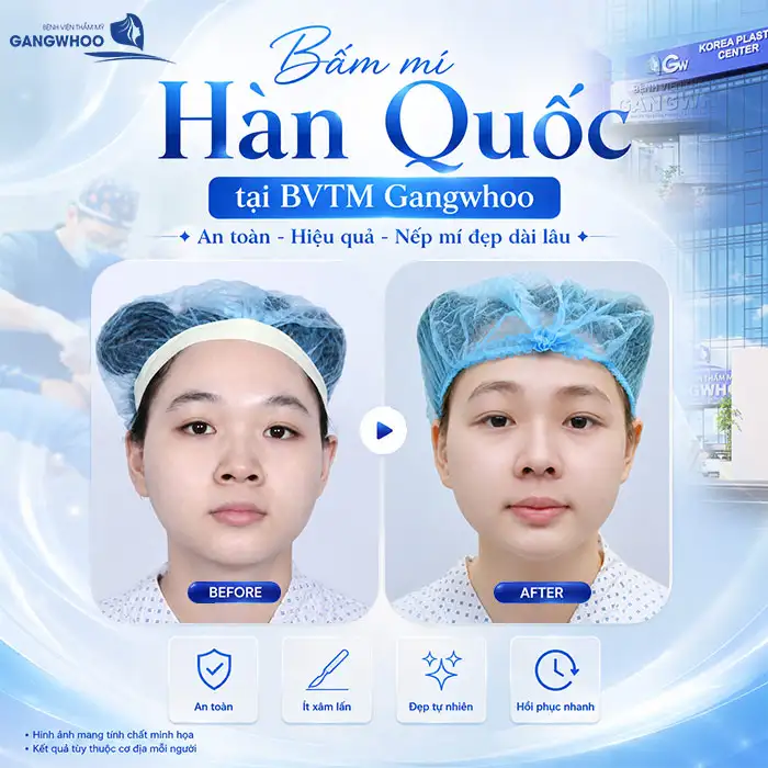 Bấm mí Hàn Quốc có an toàn không? Cần lưu ý những gì?