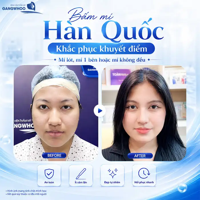 Bấm mí Hàn Quốc có an toàn không? Cần lưu ý những gì?
