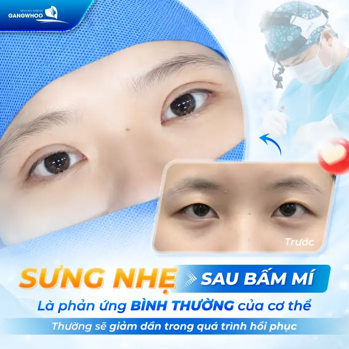 Bấm mí mắt bao lâu thì hết sưng? Cách giảm sưng hiệu quả