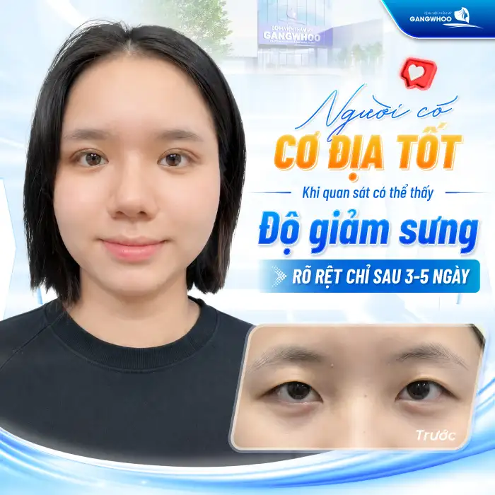 Bấm mí mắt bao lâu thì hết sưng? Cách giảm sưng hiệu quả