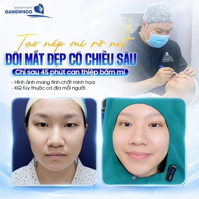 Bấm mí mắt giá bao nhiêu? Cập nhật bảng giá bấm mí 2025