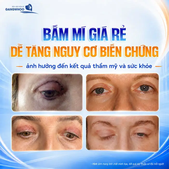 Bấm mí mắt giá bao nhiêu? Cập nhật bảng giá bấm mí 2025