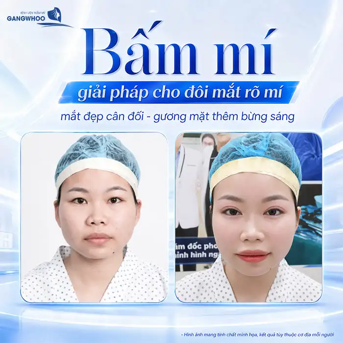 Bấm mí mắt giá bao nhiêu? Cập nhật bảng giá bấm mí 2025