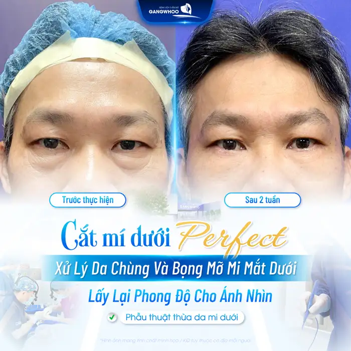 Cắt Mí Mắt Vi Phẫu Là Gì? Giải Pháp Tạo Mí An Toàn, Chuẩn Y Khoa