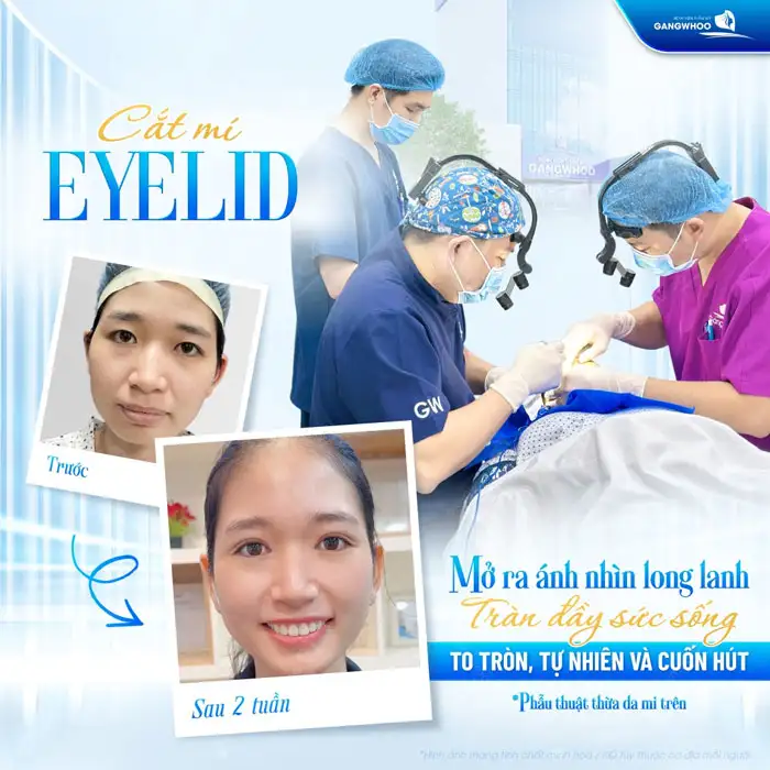 Cắt Mí Mắt Vi Phẫu Là Gì? Giải Pháp Tạo Mí An Toàn, Chuẩn Y Khoa