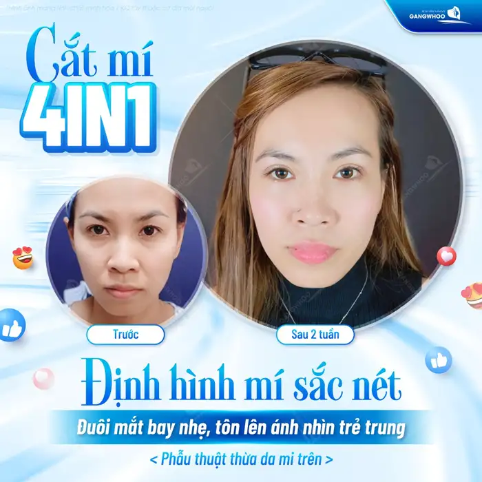 Cắt Mí Mắt Vi Phẫu Là Gì? Giải Pháp Tạo Mí An Toàn, Chuẩn Y Khoa