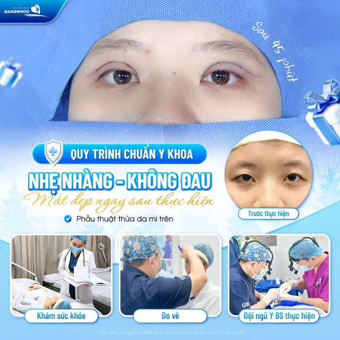 Cắt Mí Mắt Vi Phẫu Là Gì? Giải Pháp Tạo Mí An Toàn, Chuẩn Y Khoa
