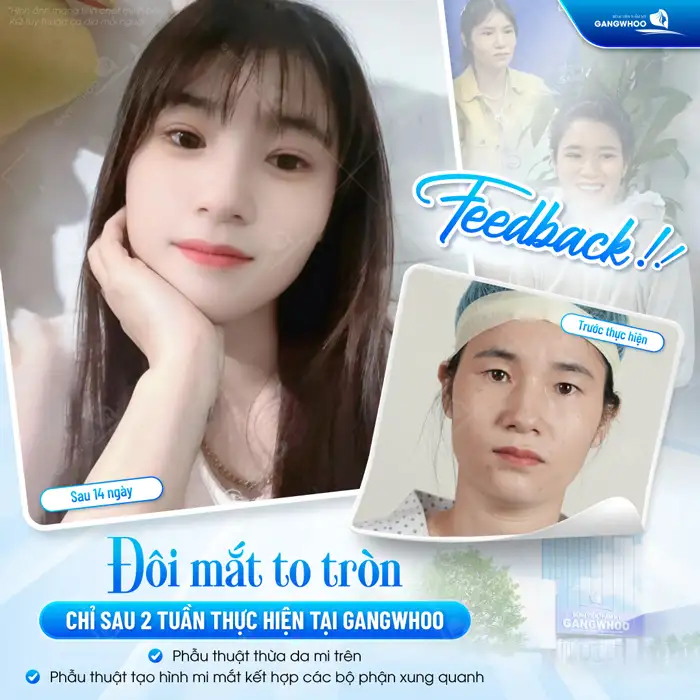 Cắt Mí Mắt Vi Phẫu Là Gì? Giải Pháp Tạo Mí An Toàn, Chuẩn Y Khoa