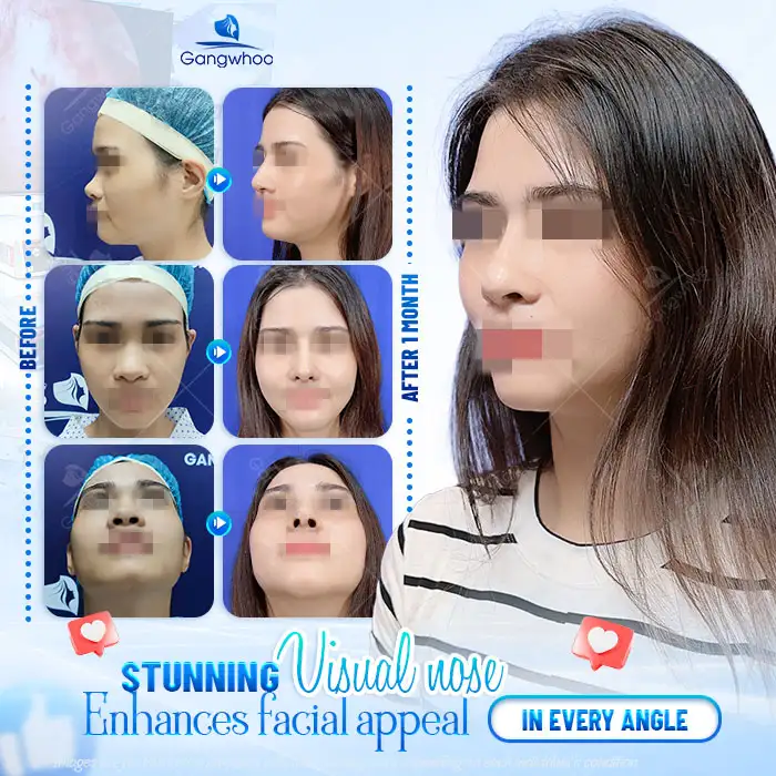 What Is Ergonomic Rhinoplasty? Advantages and Disadvantages of the Ergonomic Method