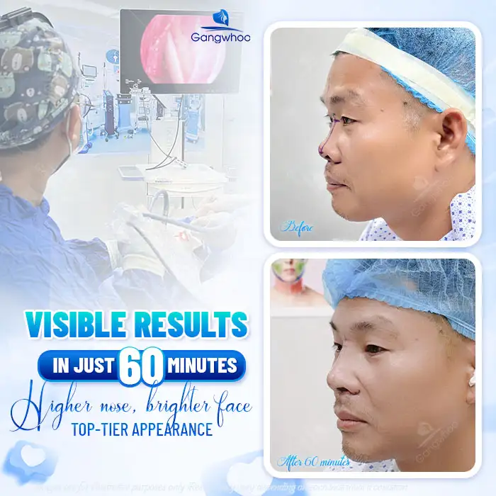 What Is Ergonomic Rhinoplasty? Advantages and Disadvantages of the Ergonomic Method