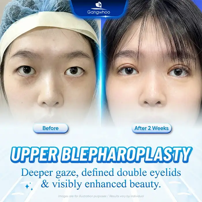 At what age can eyelid surgery be performed? Is it advisable to undergo eyelid surgery early?