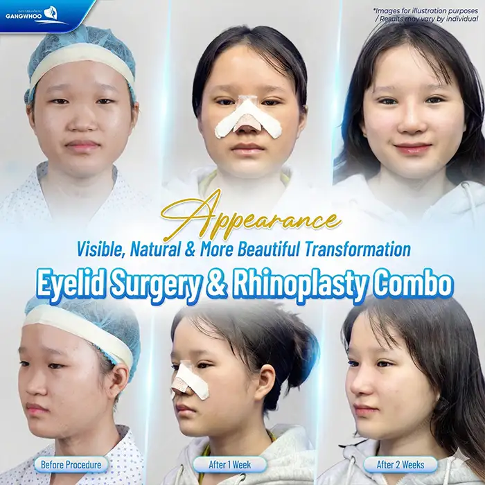 At what age can eyelid surgery be performed? Is it advisable to undergo eyelid surgery early?