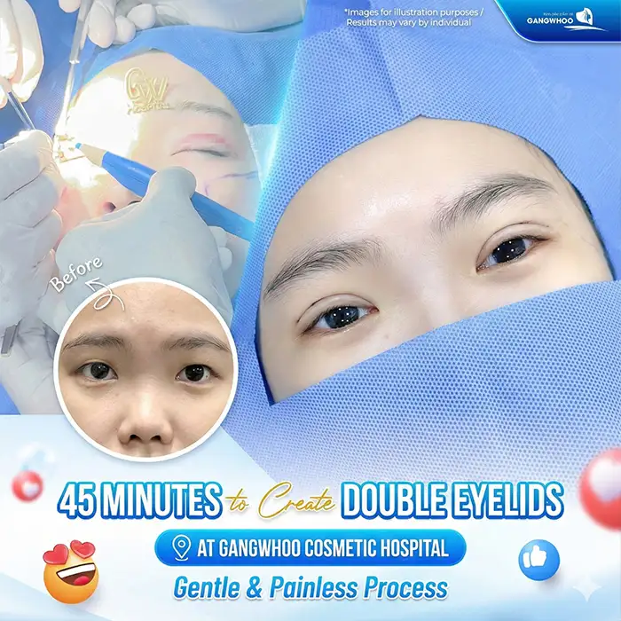 At what age can eyelid surgery be performed? Is it advisable to undergo eyelid surgery early?