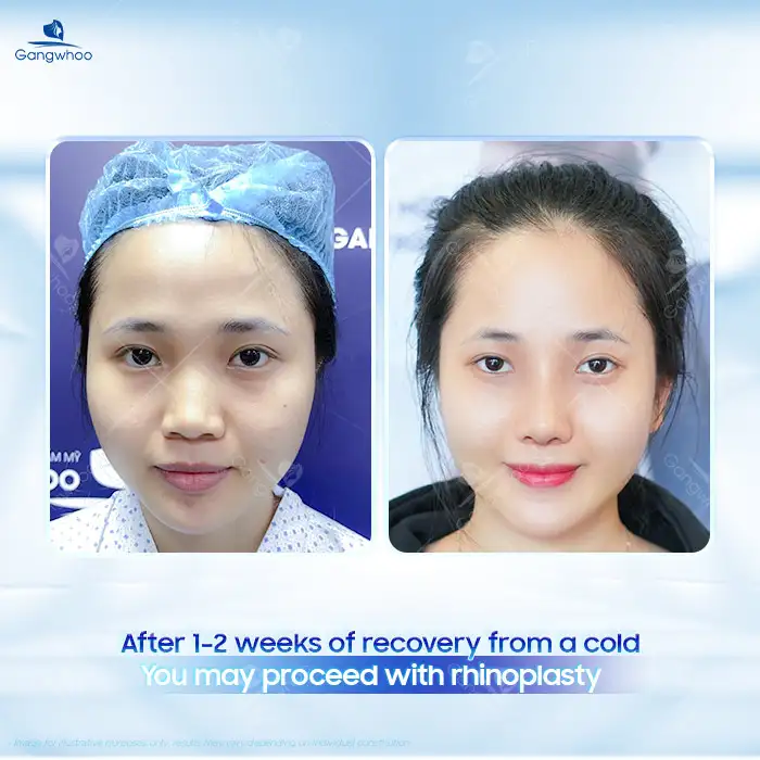 Is it safe to undergo rhinoplasty when you have a cold? Can it cause complications?
