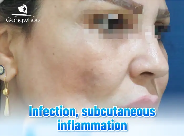 What are the complications of thread facelift? Are they dangerous to health?