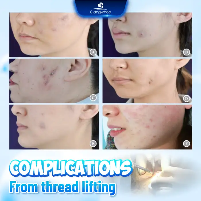 What are the complications of thread facelift? Are they dangerous to health?
