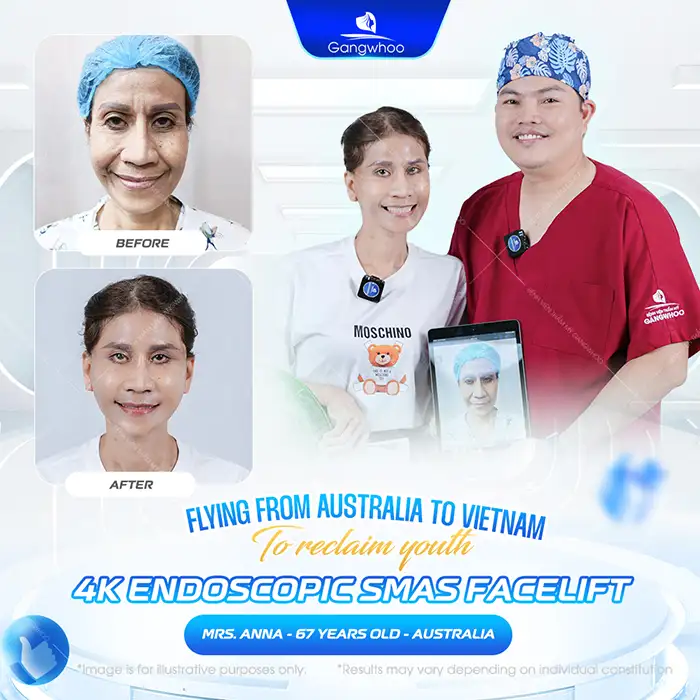 What are the complications of thread facelift? Are they dangerous to health?