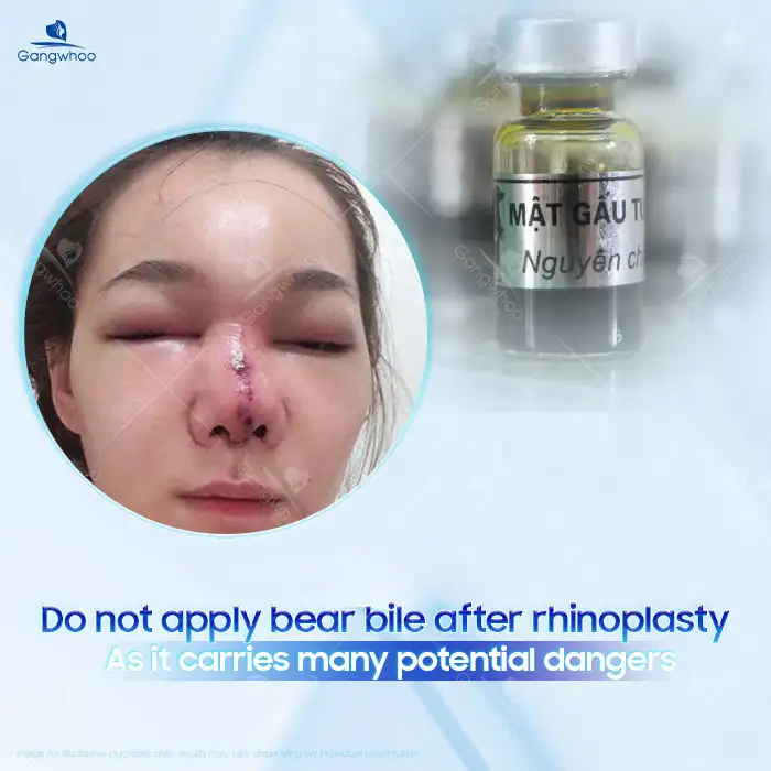 Is applying bear bile after rhinoplasty effective? Does it pose risks to the nose after surgery?