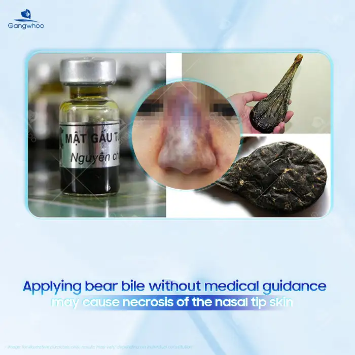 Is applying bear bile after rhinoplasty effective? Does it pose risks to the nose after surgery?