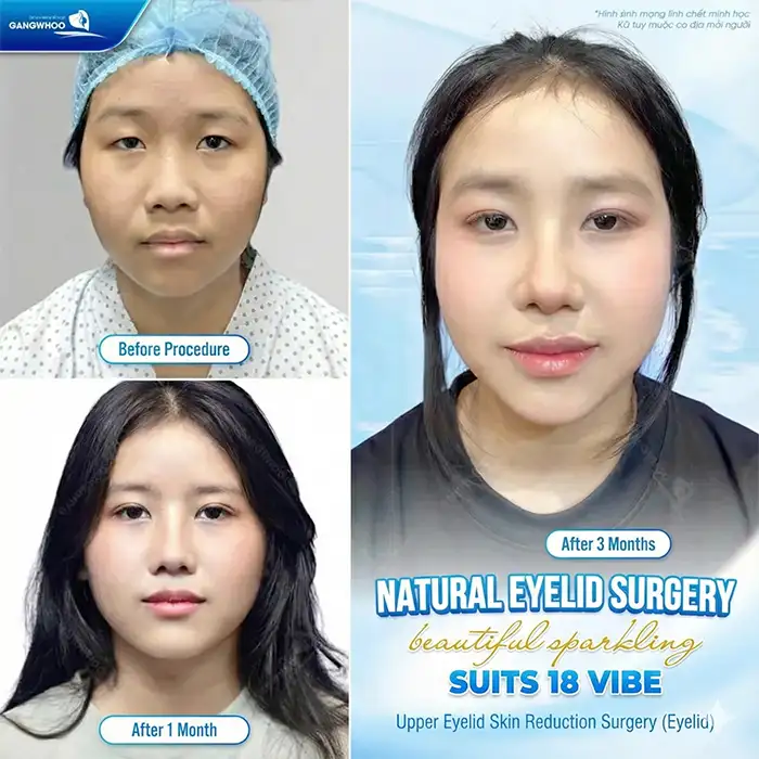 How should eyelids be cared for after stitch removal? What should be noted?