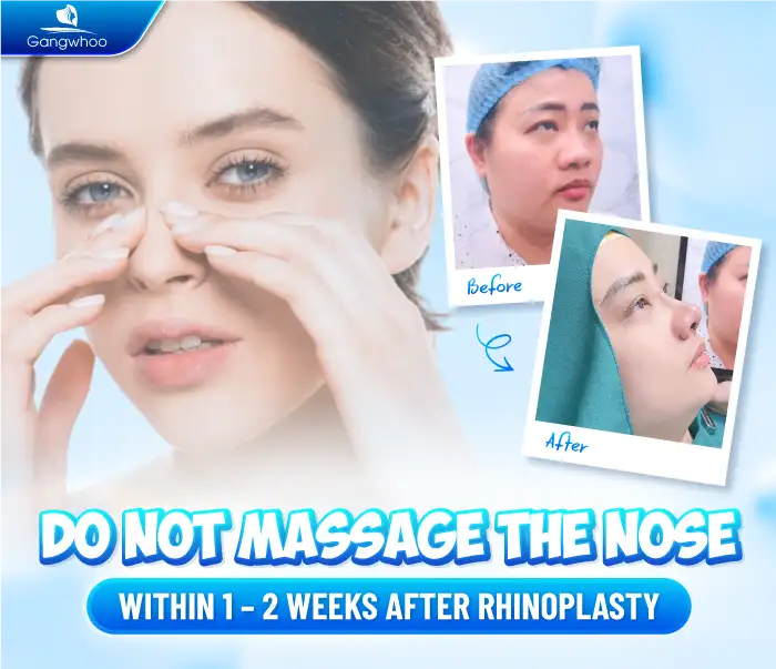 What is the proper standard of aftercare following S Line rhinoplasty?