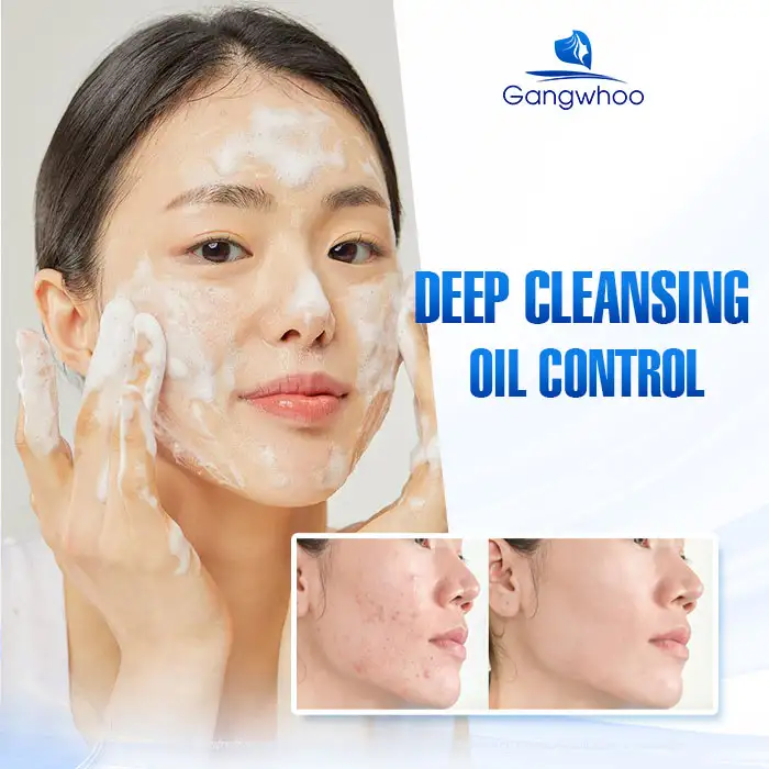 9+ Effective and Simple Ways to Treat Under-the-Skin Acne 2 9+ Effective and Simple Ways to Treat Under-the-Skin Acne