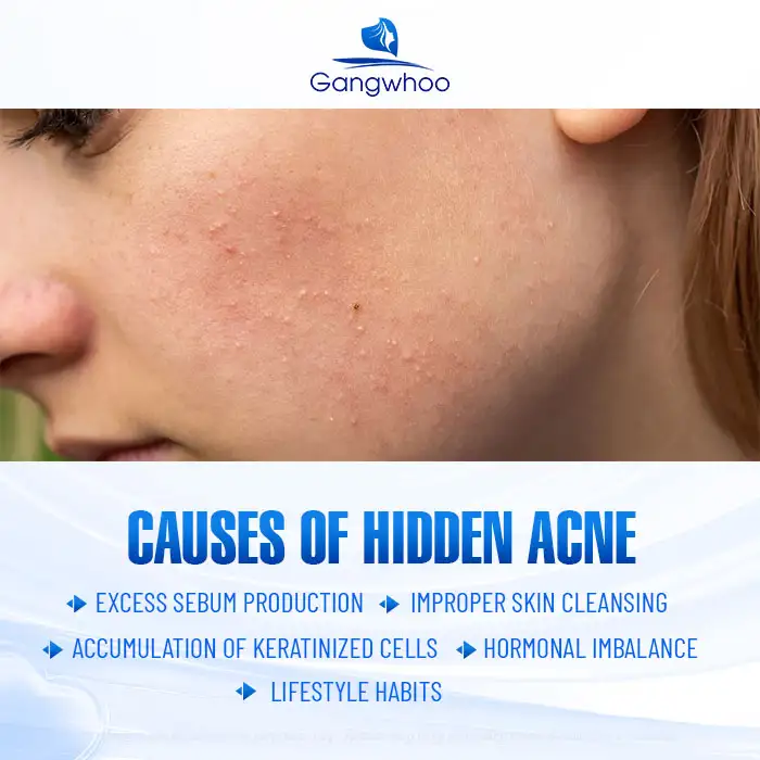 9+ Effective and Simple Ways to Treat Under-the-Skin Acne 1 9+ Effective and Simple Ways to Treat Under-the-Skin Acne