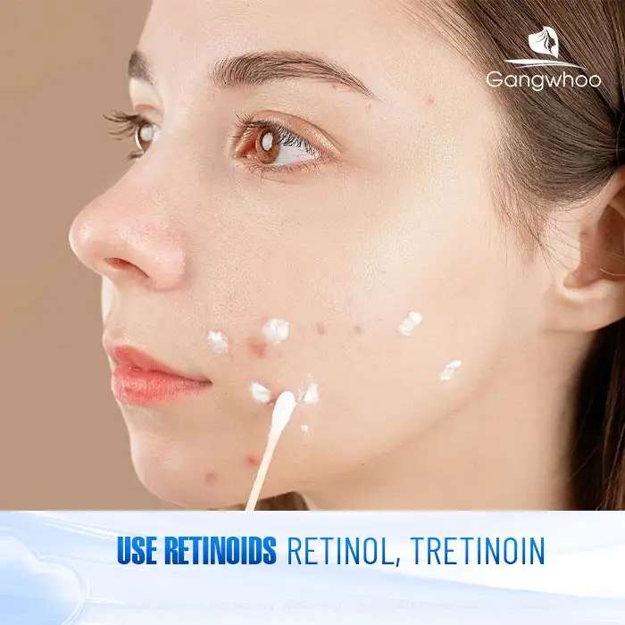 9+ Effective and Simple Ways to Treat Under-the-Skin Acne 4 9+ Effective and Simple Ways to Treat Under-the-Skin Acne