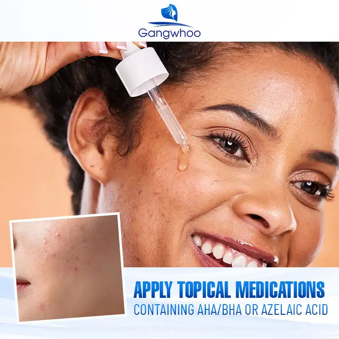 9+ Effective and Simple Ways to Treat Under-the-Skin Acne 5 9+ Effective and Simple Ways to Treat Under-the-Skin Acne