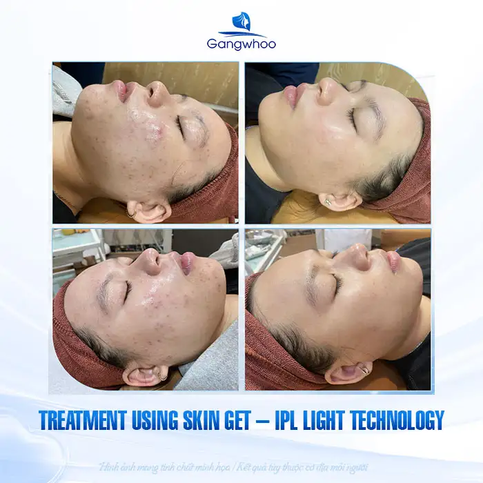 9+ Effective and Simple Ways to Treat Under-the-Skin Acne 3 9+ Effective and Simple Ways to Treat Under-the-Skin Acne