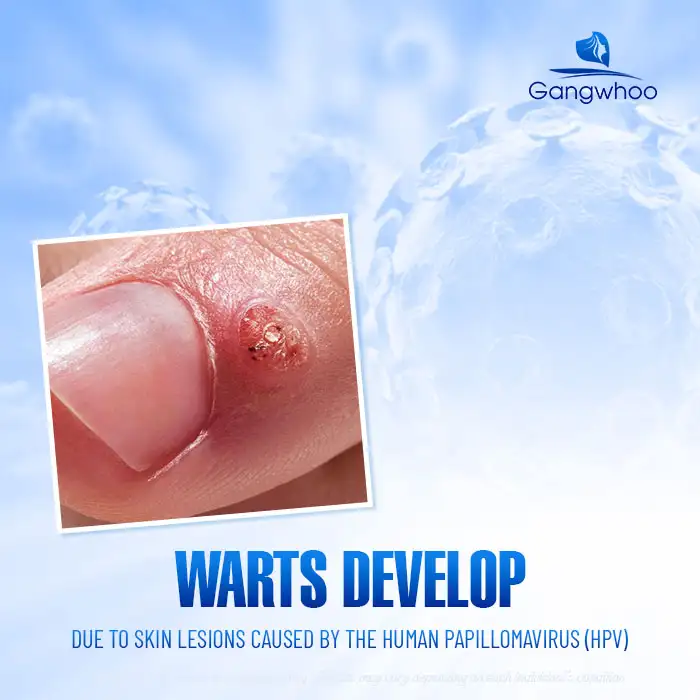 9+ Effective, Safe, and Root-Cause Wart Treatment Methods