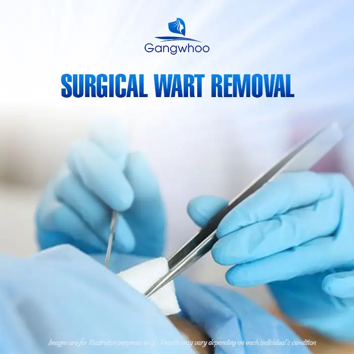 9+ Effective, Safe, and Root-Cause Wart Treatment Methods