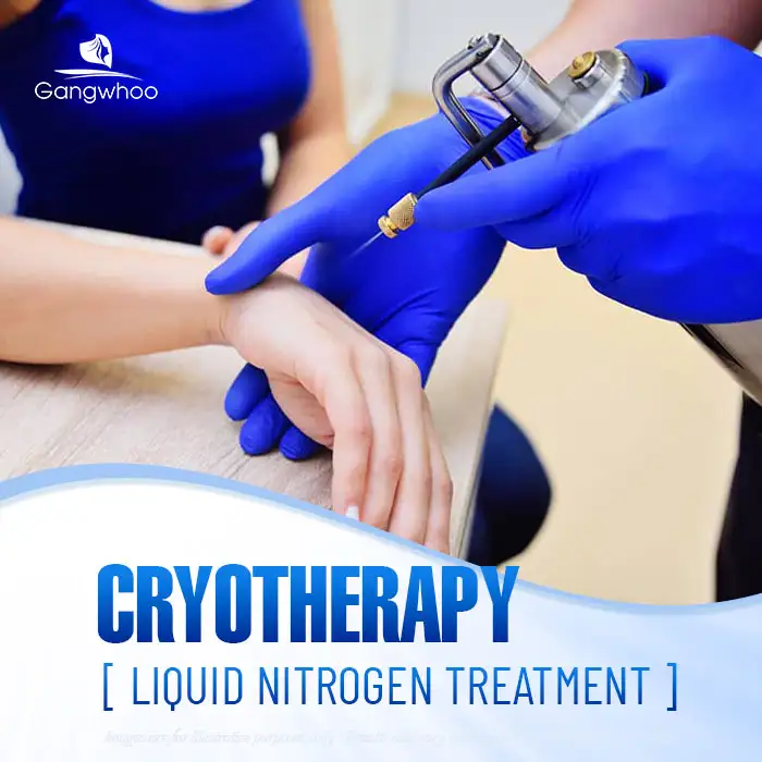 9+ Effective, Safe, and Root-Cause Wart Treatment Methods