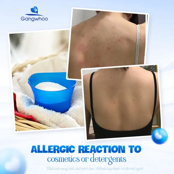 11+ Effective and Safe Back Acne Treatments You Can Do at Home