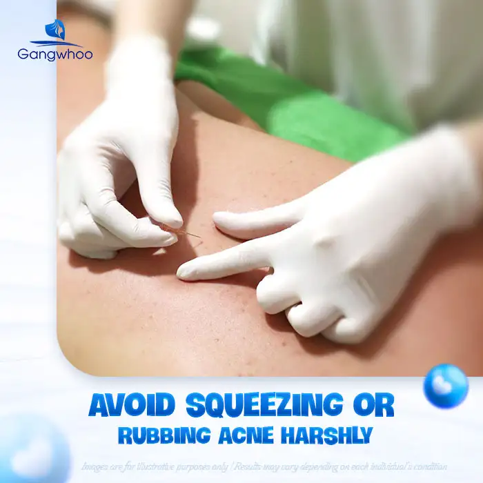 11+ Effective and Safe Back Acne Treatments You Can Do at Home