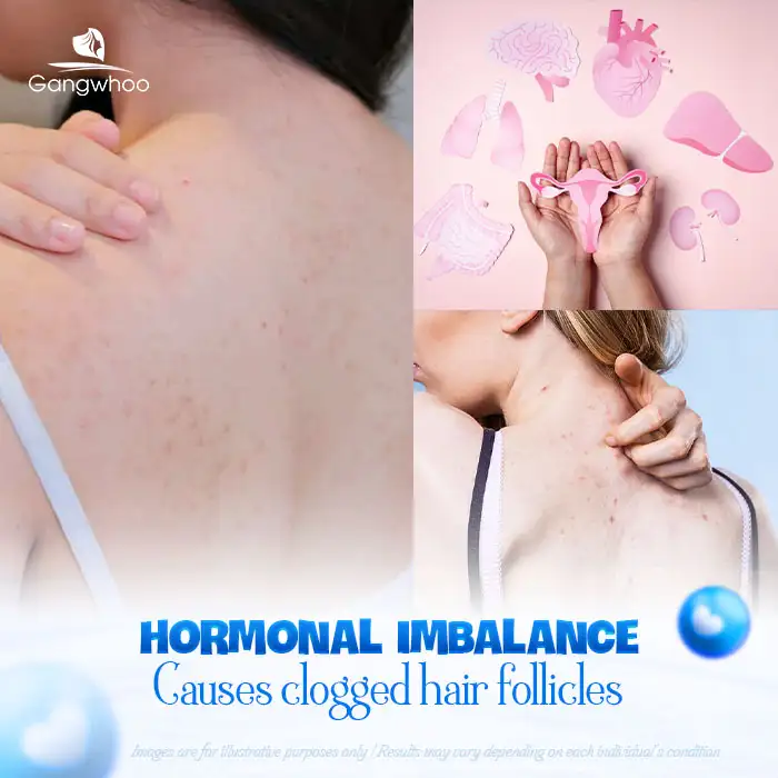 11+ Effective and Safe Back Acne Treatments You Can Do at Home